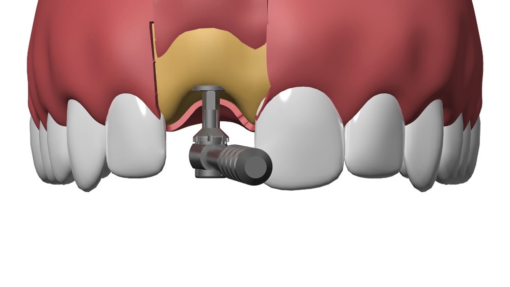 Implant dentaire Nimes David Fernandez